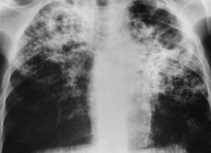 La tuberculosis pulmonar