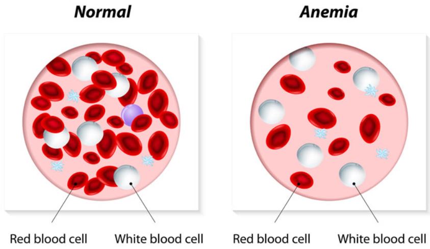 Ejemplo de anemia en personas vegetarianas