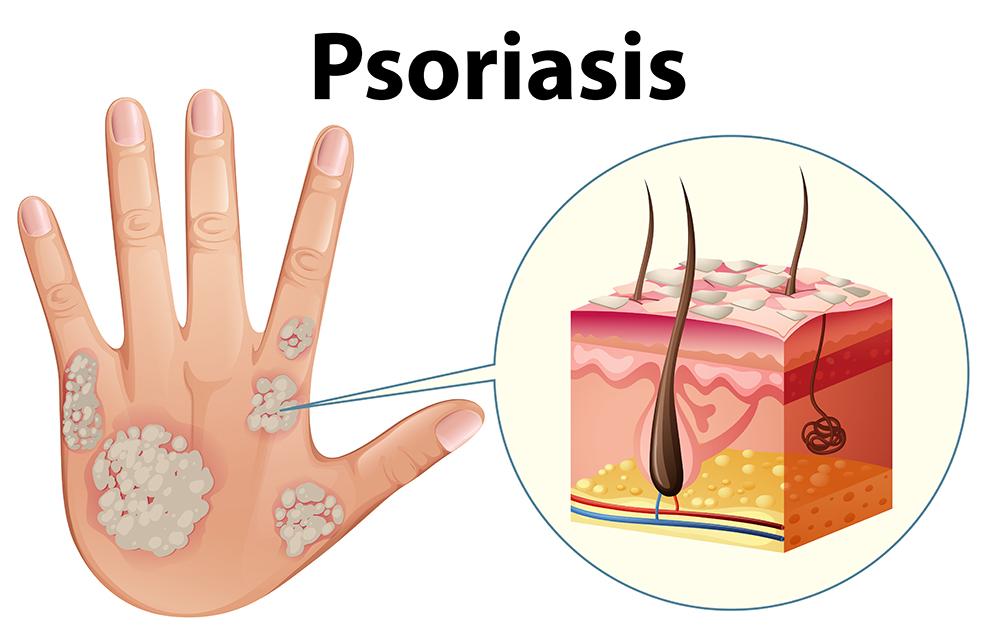 psoriasis de la piel